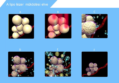 LIPO lézer működési elve