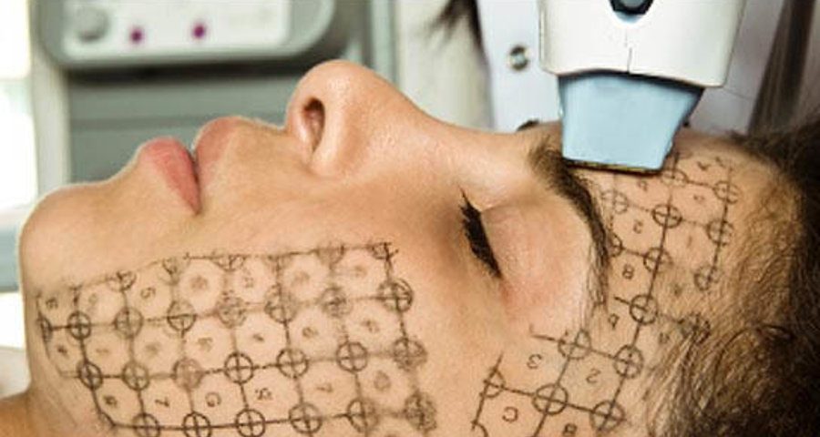Rádiófrekvenciás kezelés folyamata, thermage rf arc és testkezelő